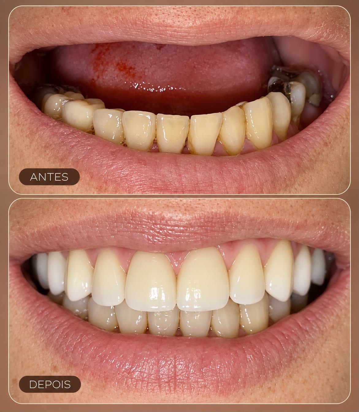 Antes e depois de reabilitação da arcada superior sobre implantes, com os dentes inferiores do paciente preservados