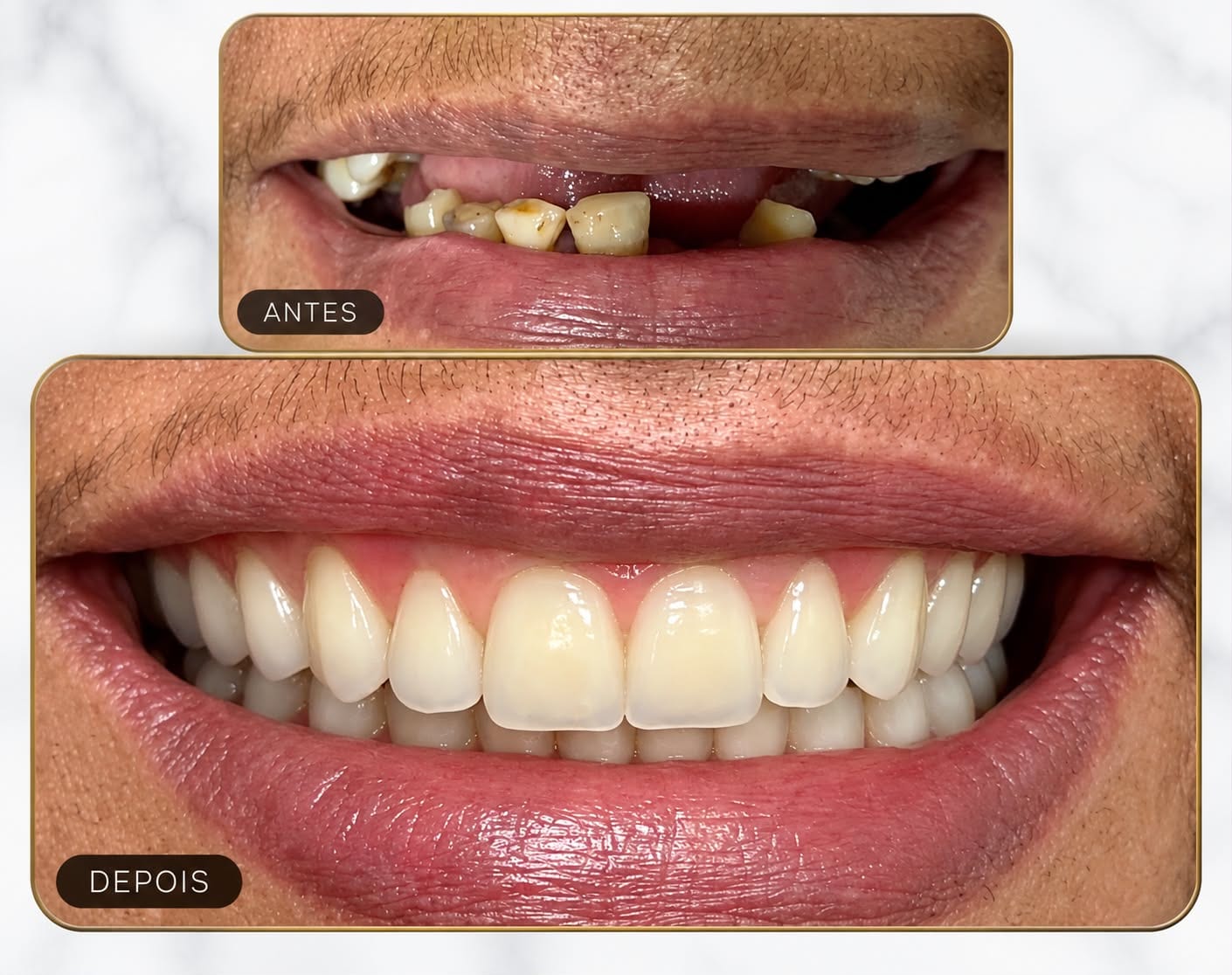 Antes e depois de reabilitação com prótese fixa sobre implantes, substituindo dentes comprometidos