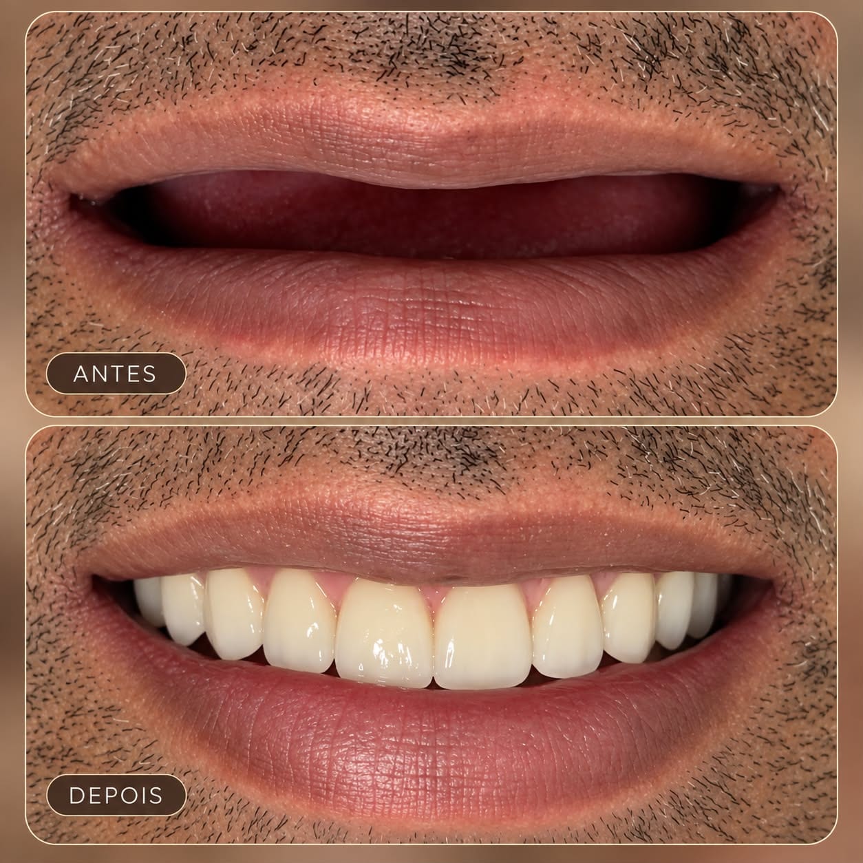 Antes e depois de protocolo fixo superior sobre implantes