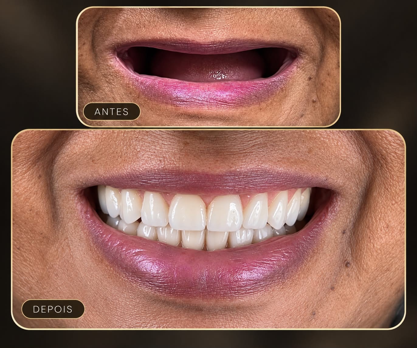 Antes e depois de reabilitação das duas arcadas sobre implantes, a partir de uma condição sem dentes