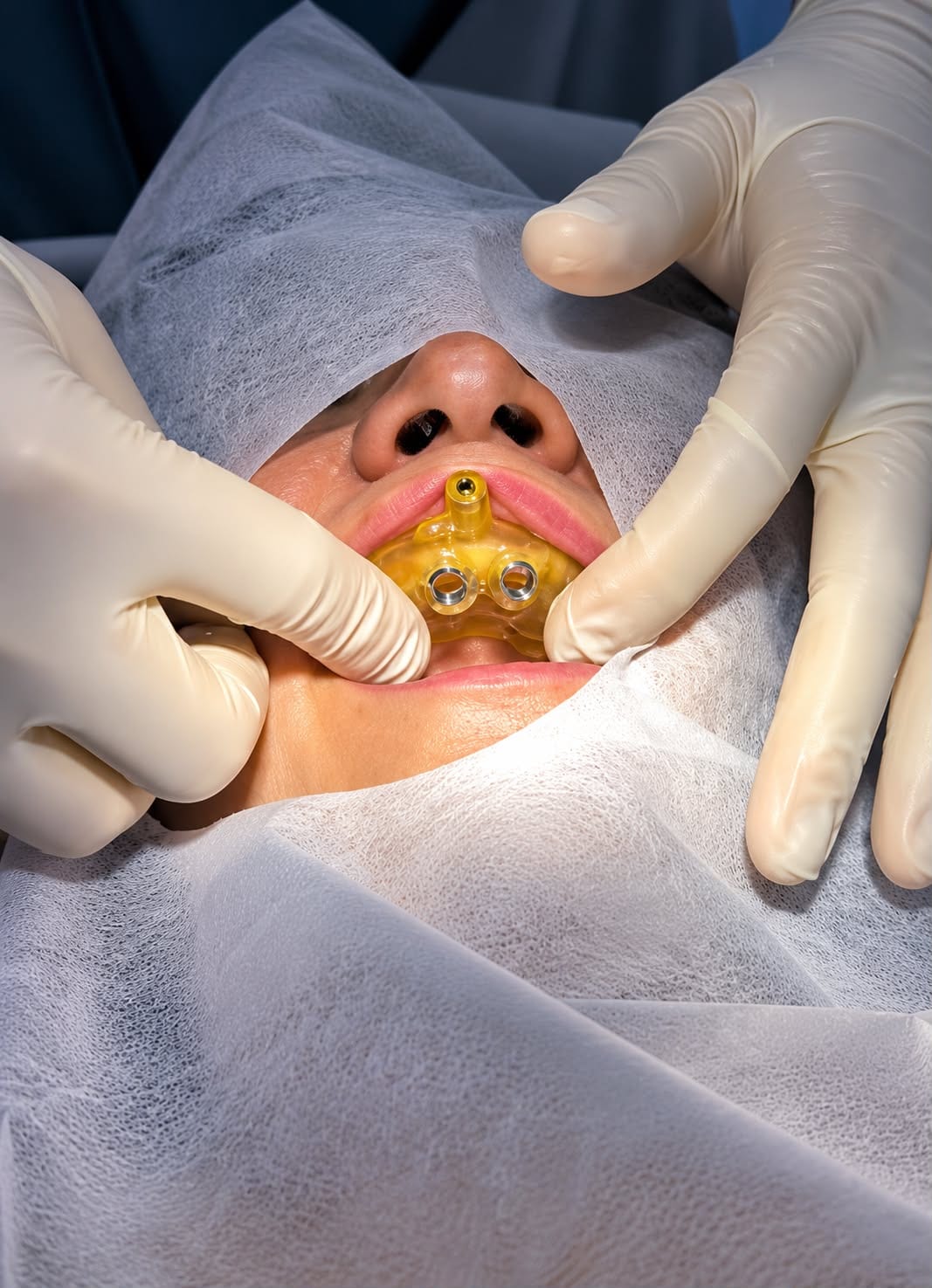 Guia cirúrgico impresso em 3D posicionado na boca do paciente durante a cirurgia de implantes